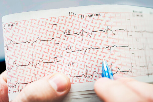 Arrítmia cardíaca: en què consisteix? - Adeslas Salud y Bienestar