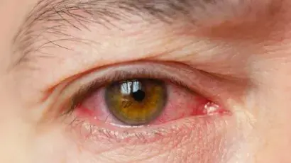 Descubre qué es la conjuntivitis y cómo prevenirla – Adeslas Salud y Bienestar