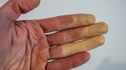 Descubre qué es y qué síntomas tiene el síndrome de Raynaud - Salud y Bienestar