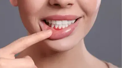 Descubre qué es y por qué se produce la periodontitis – Adeslas Salud y Bienestar