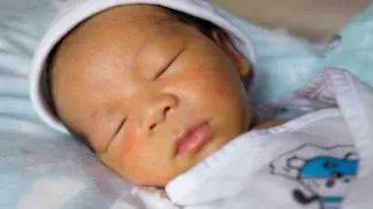 Ictericia neonatal: qué es y cómo tratarla - Adeslas Salud y Bienestar