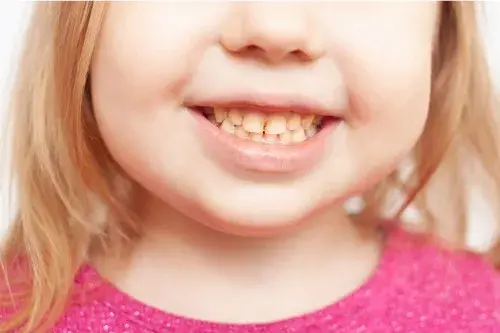 ¿Por qué cambia el color de los dientes de mi hijo?