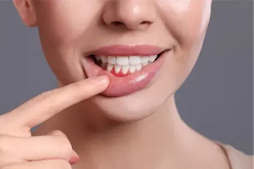 Periodontitis: qué es y por qué se produce