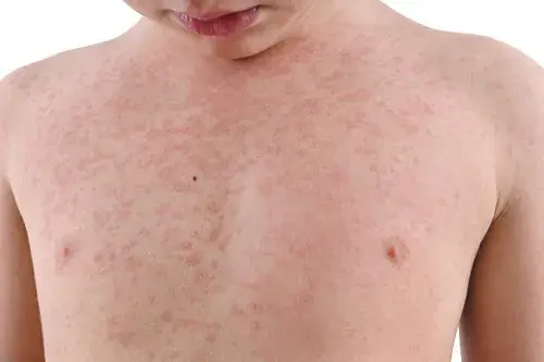 ¿Cómo identificar la urticaria en niños?